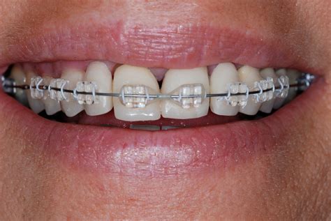Orthodontics .
